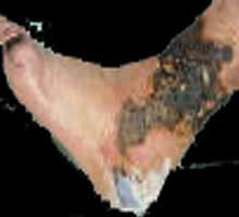 ARTERIOSCLEROSIS�OBLITERANTE�