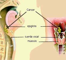 PHARYNX�CANCER�