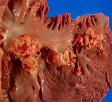 ENDOCARDITIS�