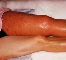 ERYTHEMATOUSLUPUS